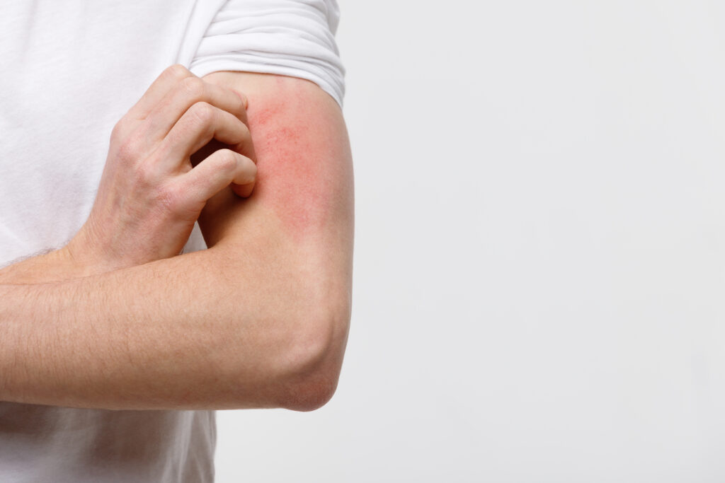 eczema eczema causes eczema treatment itchy Singapore asthma allergic rhinitis atopic dermatitis
